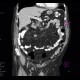 Tumour of jejunum: CT - Computed tomography